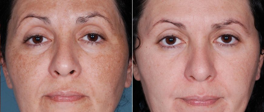 peeling-chimic-galati-alina