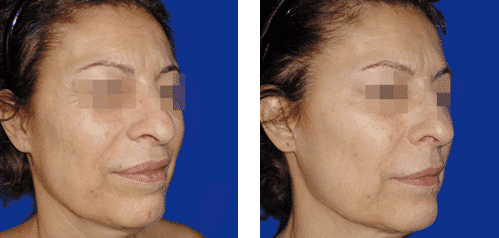 peeling chimic mesoestetic galati
