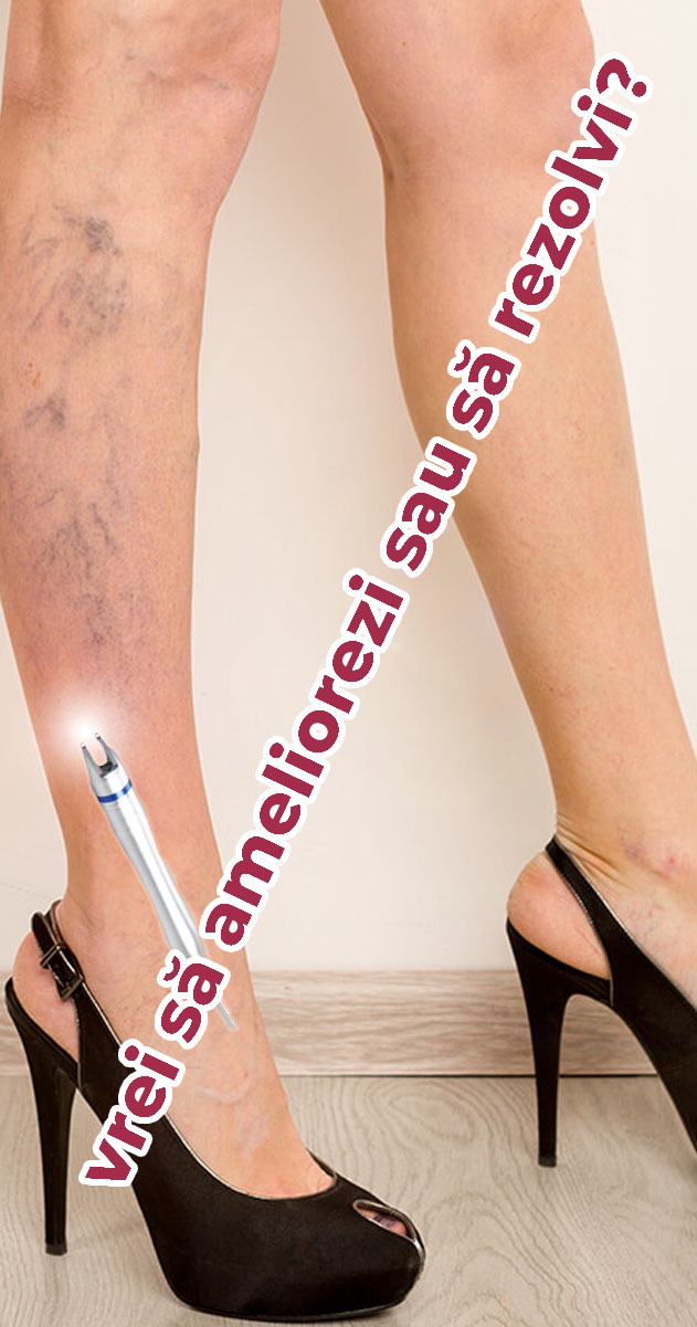 venectazii capilare sparte